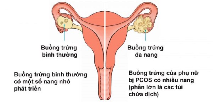 Buồng trúng đa nang